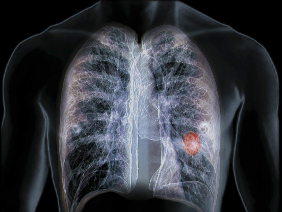 45歲女子確診晚期肺癌，不抽煙不喝酒，只因長期在做兩件事！ 健康 第1張