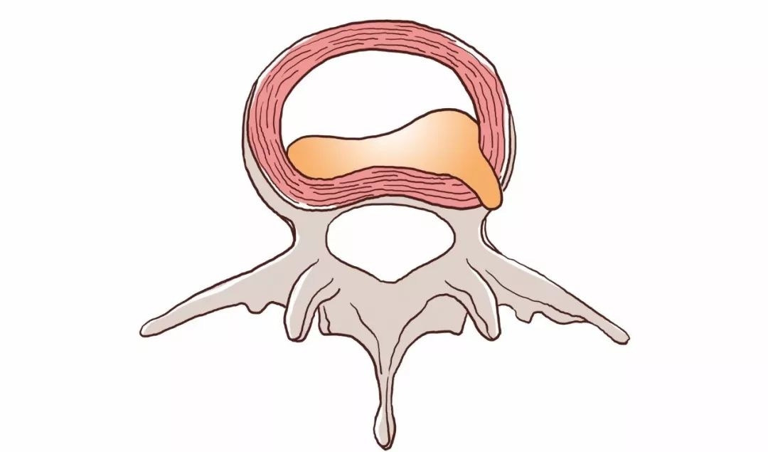 你是怎么把腰椎间盘逼得如此突出的?