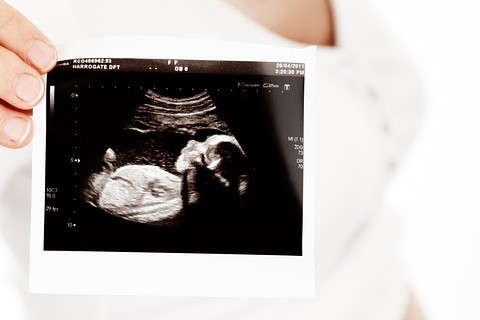 孕早期b超胎心怎么看