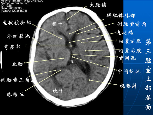 头颅ct解剖与常见出血梗死判读