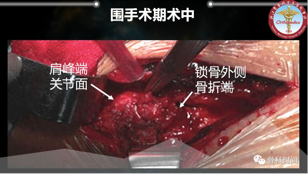 一例锁骨骨折手术教你理清治疗思路