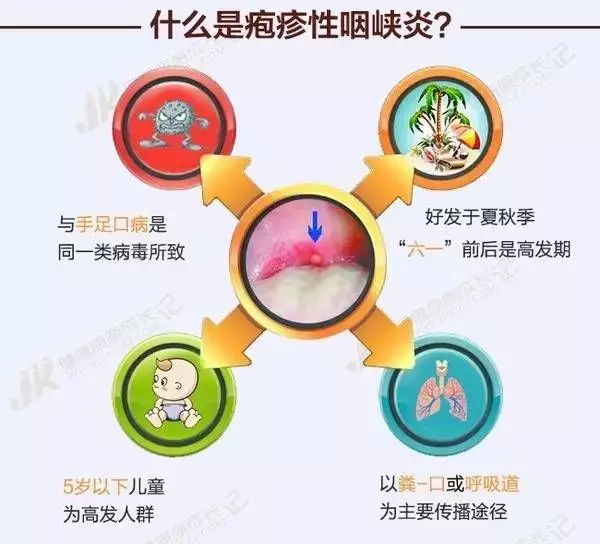 好发于秋季,它是常见的一种具有流行性的病毒性咽炎