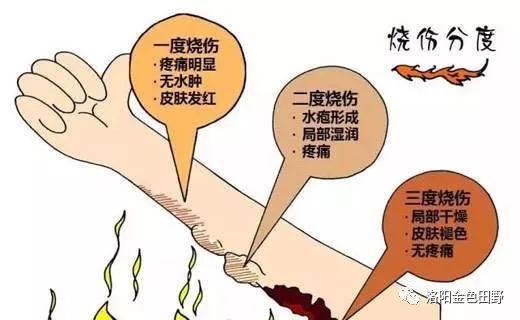 生活小贴士——烫伤后怎么科学处理?