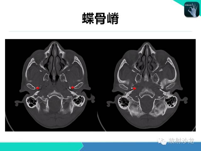 颅底骨质解剖