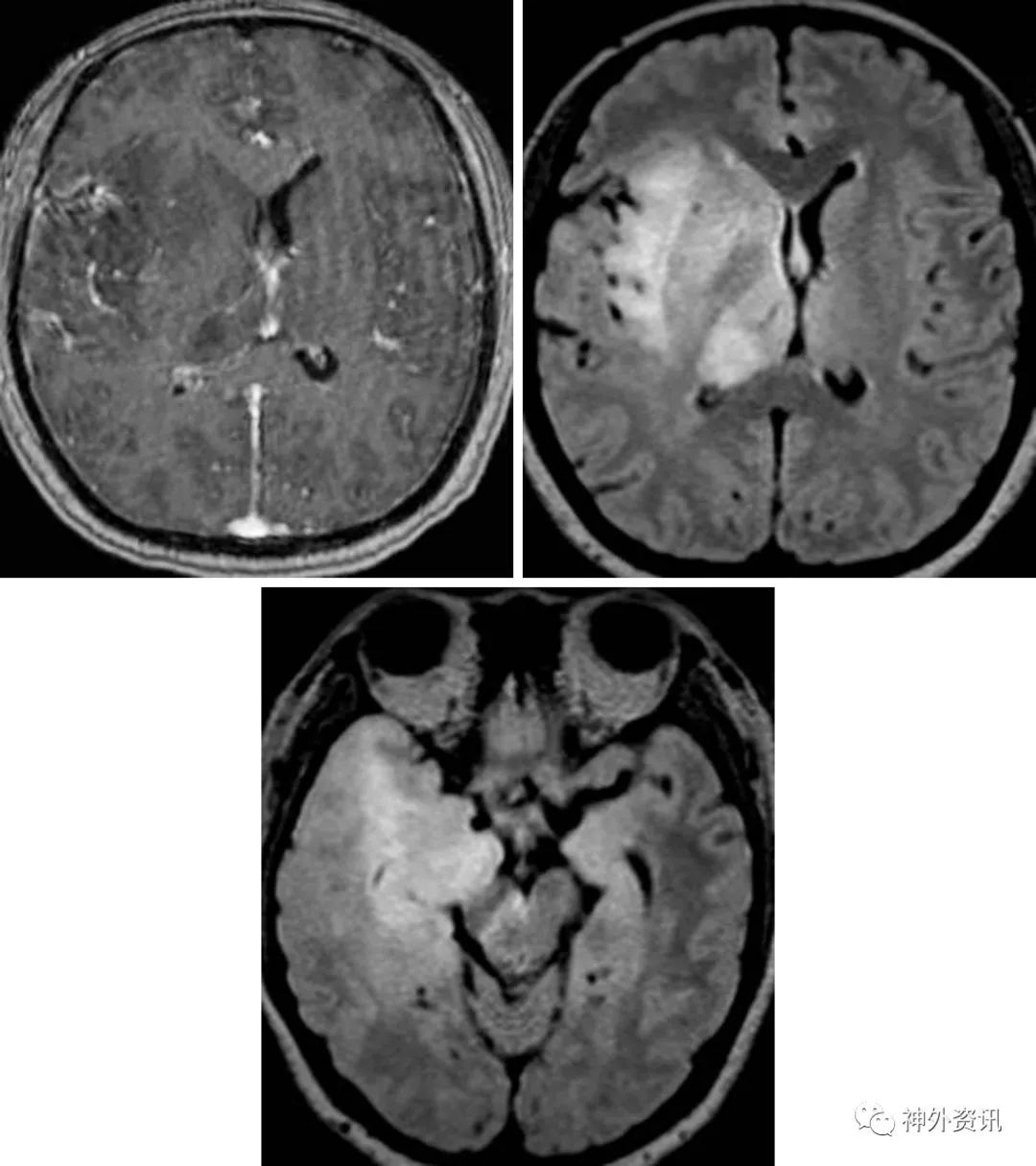 大脑胶质瘤病的影像学特征 | the neurosurgical atlas全文翻译