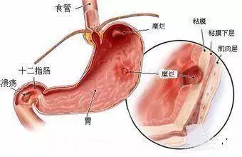 反流性胃炎怎么办