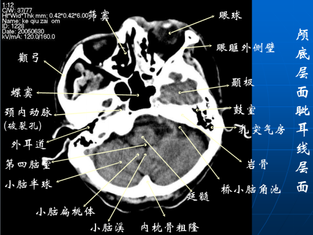 头颅ct解剖与常见出血梗死判读