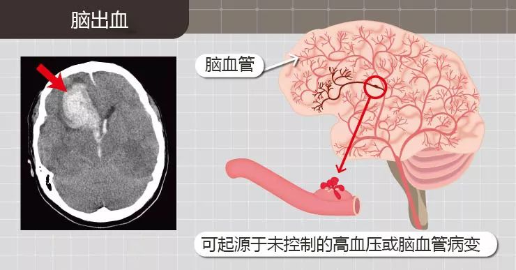 脑膜出血怎么办