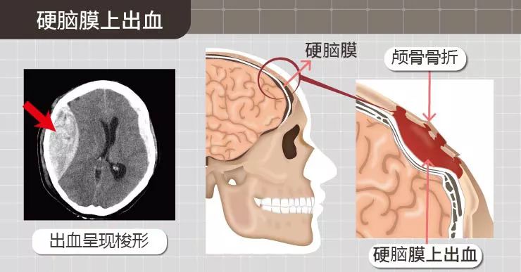 四种不同类型的颅内出血,每一种都很要命_脑膜