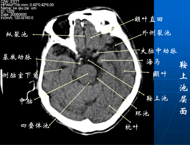 头颅ct解剖与常见出血梗死判读