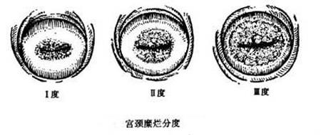 景德镇和美专家解答:宫颈糜烂二度严重吗 需不需要治疗