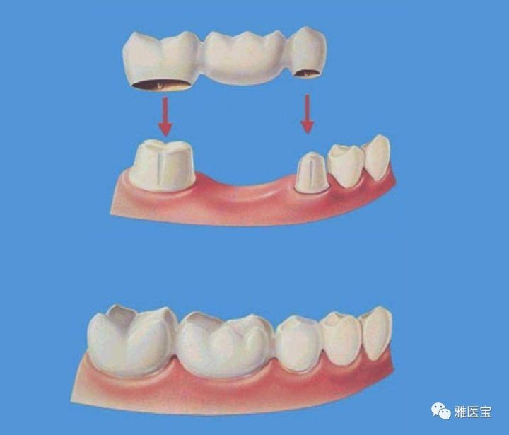 缺一颗牙却要镶三颗牙,这种属于烤瓷固定桥修复,需要旁边的两颗牙做