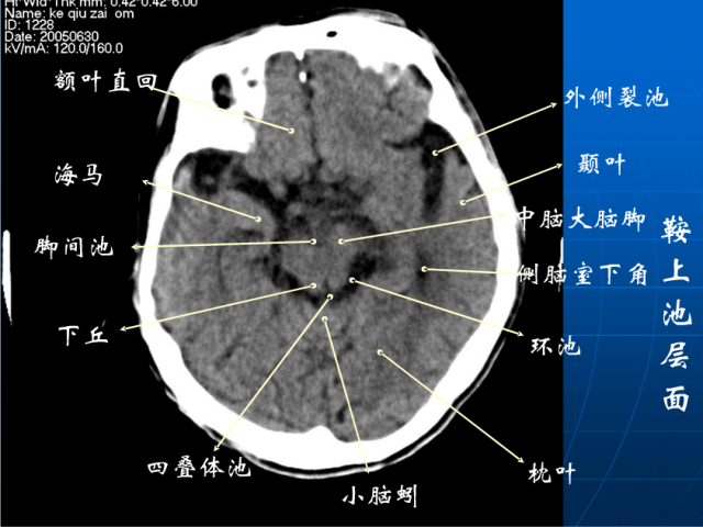 头颅ct解剖与常见出血梗死判读