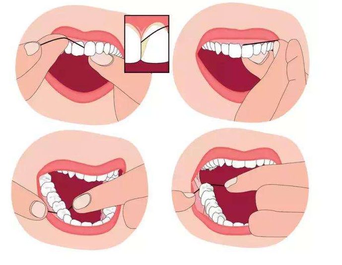 用牙线能减少牙菌斑