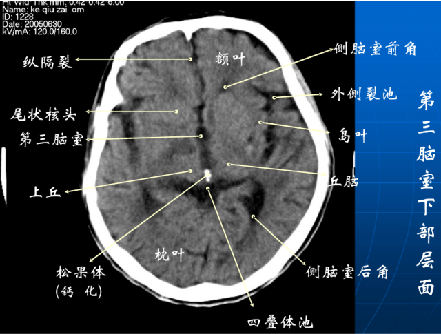 头颅ct解剖与常见出血梗死判读