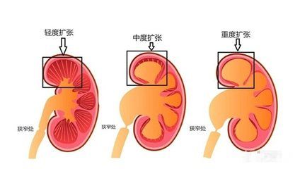 胎儿肾积水严重怎么办