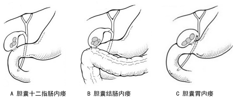 施宝民:胆囊结石反复"痛-警惕胆囊消化道内瘘的发生