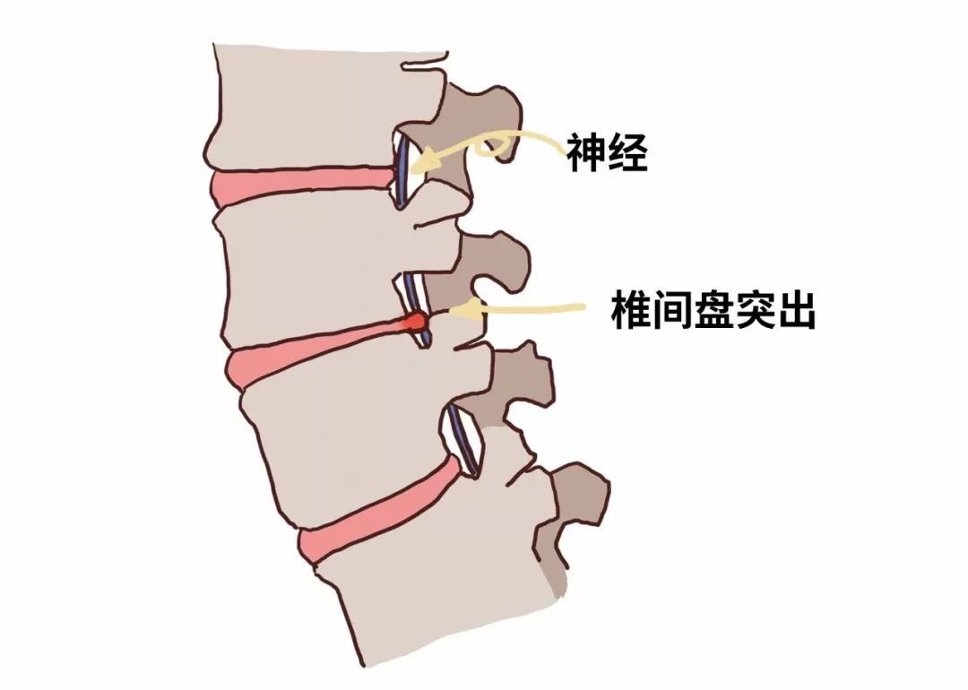 髓核含水量很高,一旦纤维环撕裂,水分会从裂缝中一点点流出,随着水分