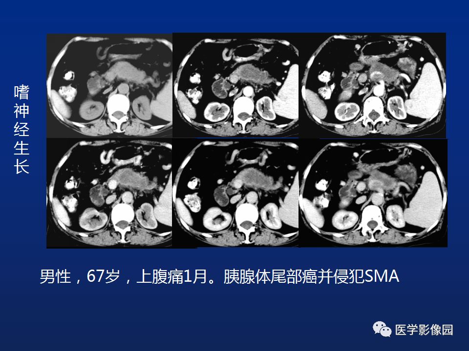 胰腺占位性病变的影像学表现