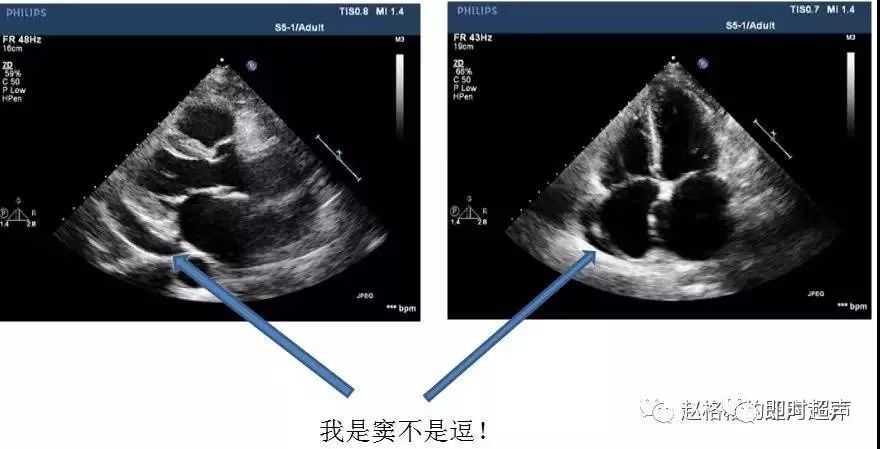 心包积液的那些坑