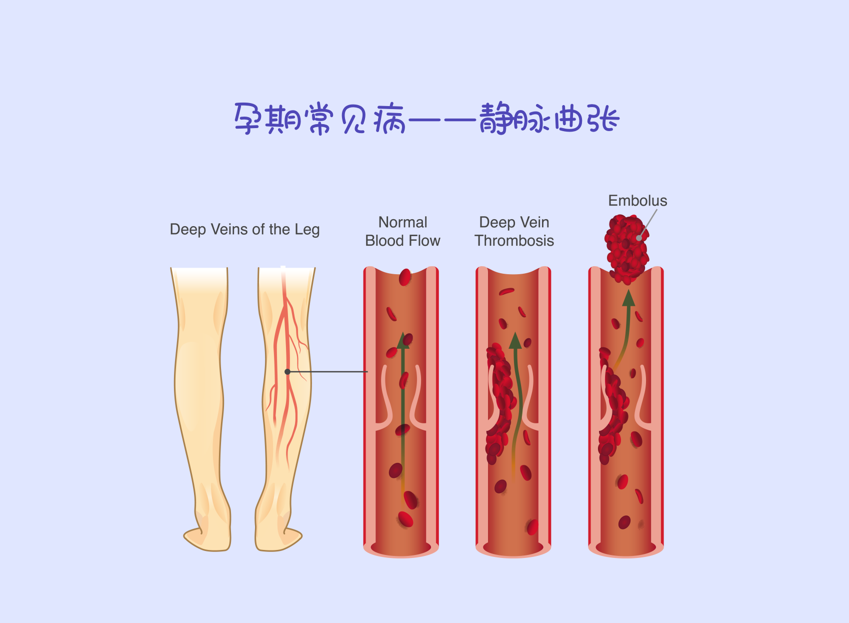 孕期高发|丑哭了的静脉曲张,不管如何都不能慌