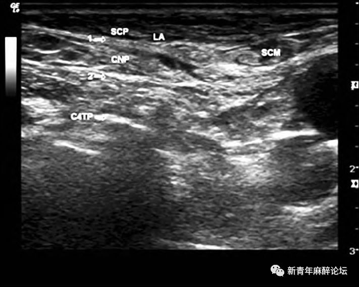 超声引导下颈浅丛争议问题专家点评_阻滞