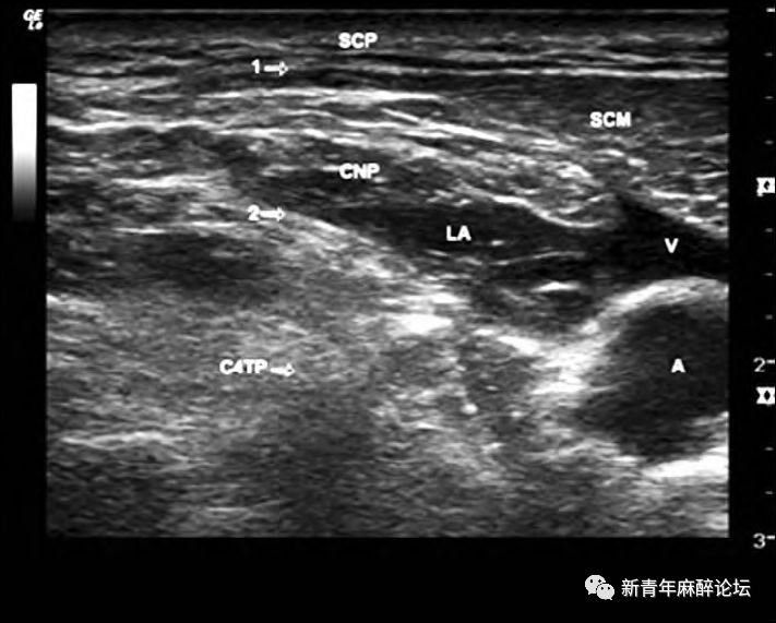 颈部筋膜层次的超声影像颈神