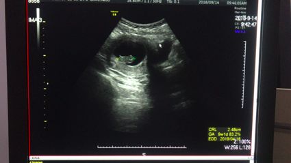 提示患者接近排卵日,本患者不考虑 术后第 5 天复查彩超:子宫前位