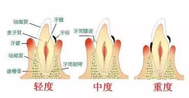 牙龈萎缩,怎么办?