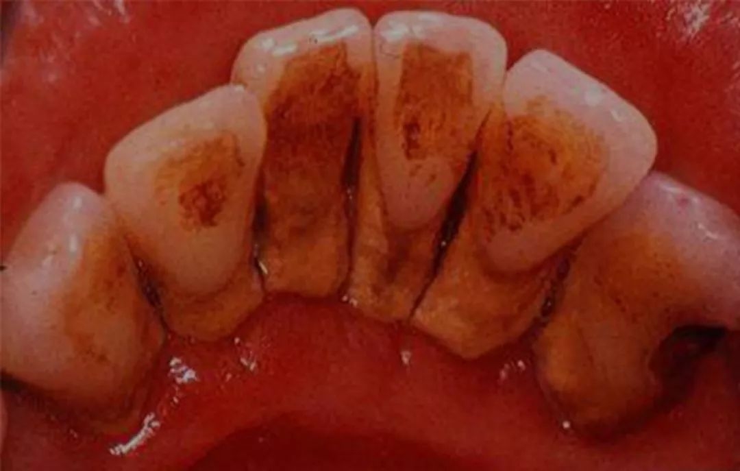 牙周病会导致牙槽骨吸收,时间越长牙根暴露越明显,牙齿缝隙也越大.