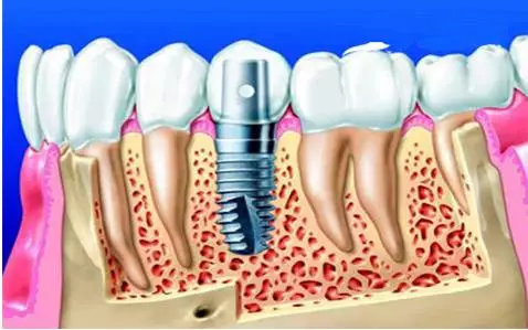 宝威体育：种植牙种类大集合让种植牙不再茫然(图2)