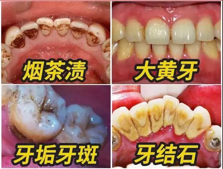 再加上牙齿敏感,口臭,牙渍,牙菌斑等 构成了中国人最常见的7大口腔