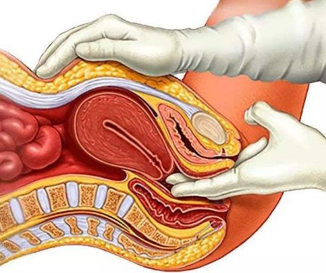 妇科"鸭嘴"检查是女性的噩梦?放轻松,别怕,它的作用挺