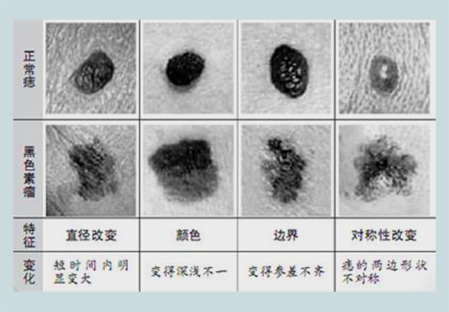 身上哪些痣会癌变? 做好这2点,你的痣就不