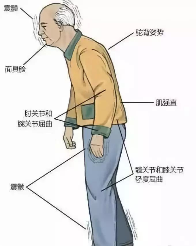 帕金森病有哪些症状呢?