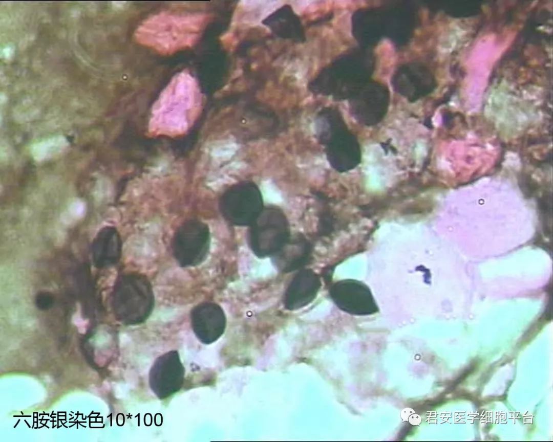 典型的特征性括弧样结构诊断结合我科纤支镜灌洗物涂片:查见肺孢子菌