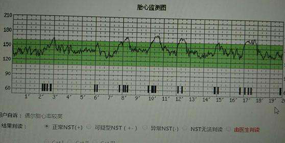 胎心监护高于160怎么办