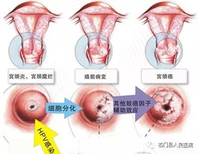 宫颈癌筛查:tct和hpv哪个更靠谱?女性朋友赶紧收藏