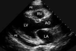 【超声微课堂】实用方法——心包积液的超声诊断和测量方法