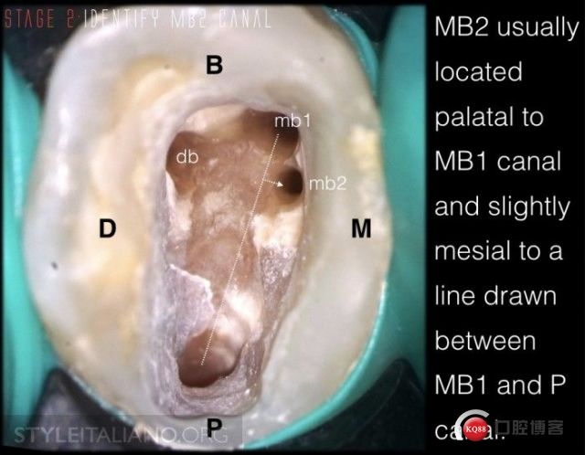 上颌mb2真的存在吗676767_根管