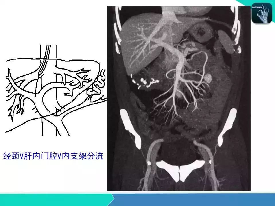 精品课件| 肝胆,门静脉解剖