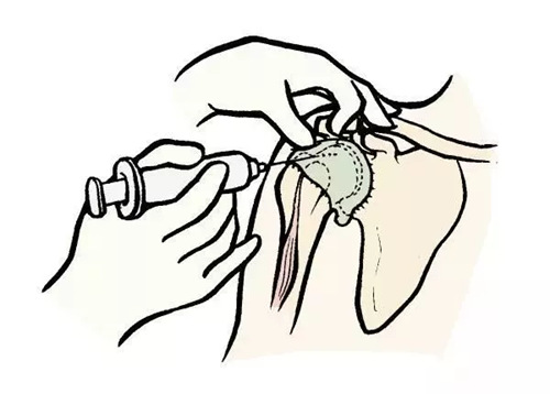 注射的部位包括肩峰下,关节腔;注射的药物包括:类固醇激素如曲安奈德