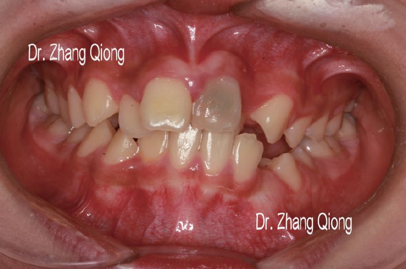 21牙陈旧性牙外伤牙髓坏死致牙冠变色
