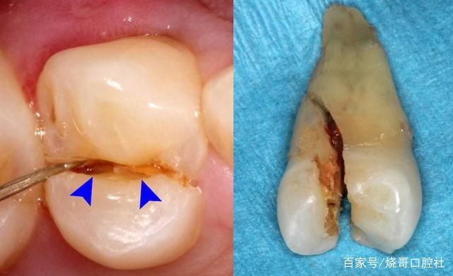 四个大牙裂开了三个,现在吃饭都困难,有什么方法解决吗?