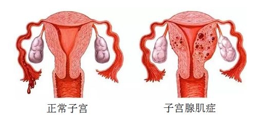 二,这个患者的症状是粘连造成的吗?