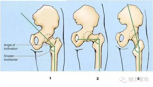 图一是所谓的"普通"的倾角.图二是髋内翻.图三是髋外翻.