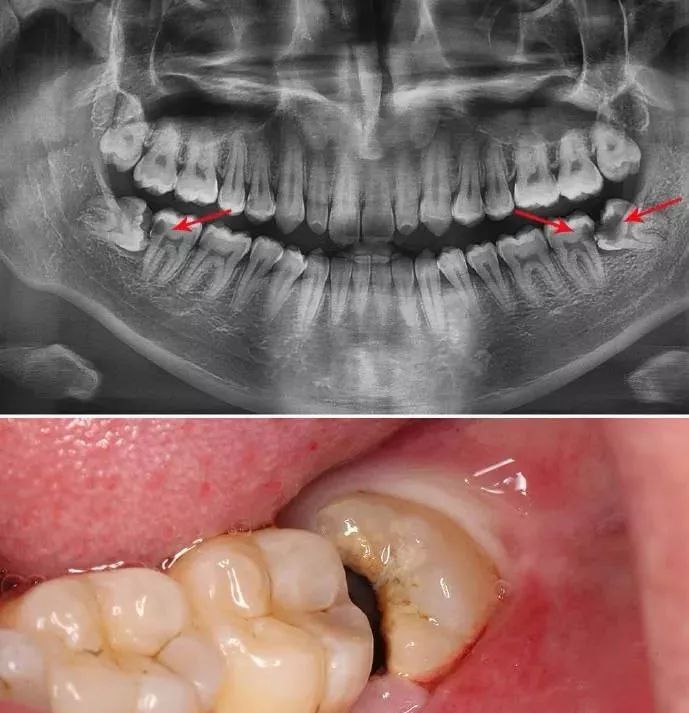 将前面的好牙顶坏,继而出现龋齿,牙齿松动的症状.1,智齿有什么危害?