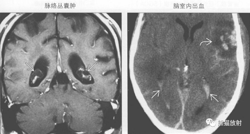 左图:冠状增强示老年病人的典型脉络丛黄色肉芽肿,囊肿壁强化,内容物