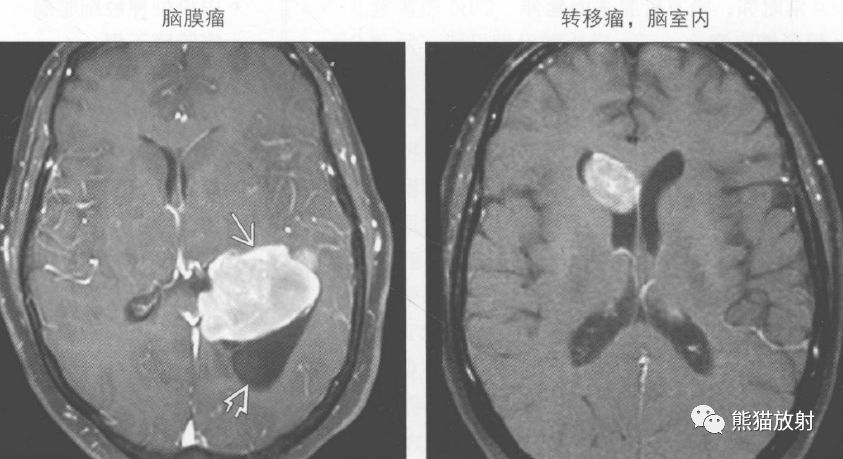 右图:ct增强示侧脑室三角区分叶状明显强化的占位,伴脑积水.