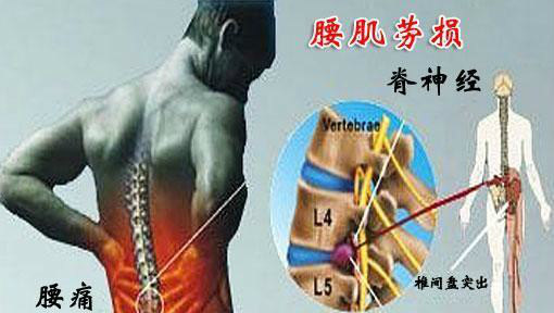 腰部肌肉劳损怎么办